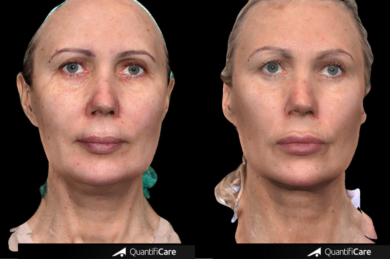 MODELOWANIE SYLWETKI – ICOONE LASER BODY
